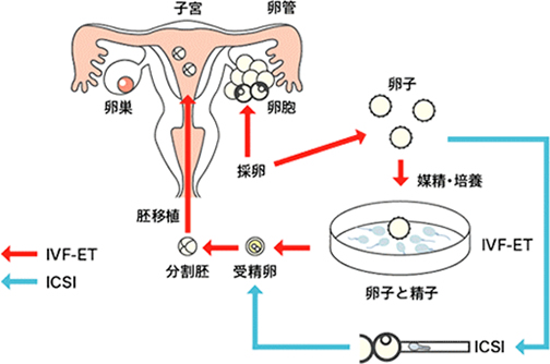 体外受精・胚移植法の適応