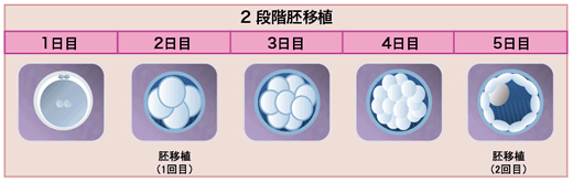 2段階胚移植のデメリット