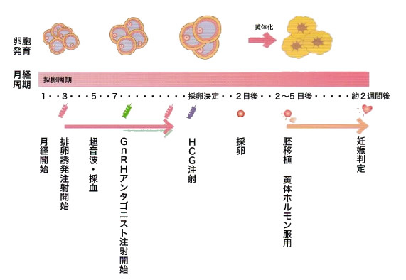 アンタゴニスト法での体外受精スケジュール