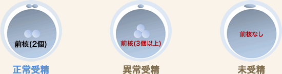 3個以上前核が確認できた場合には異常受精（染色体異常）になります