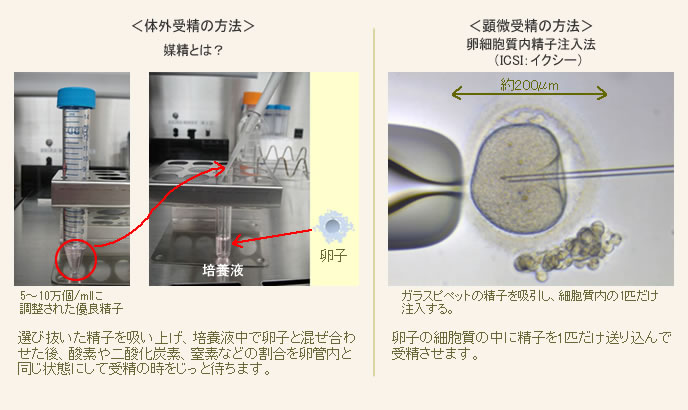 体外受精の方法・顕微授精の方法