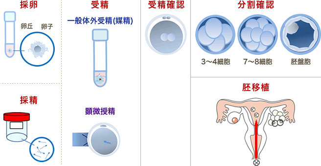 顕微授精と一般体外受精の流れ